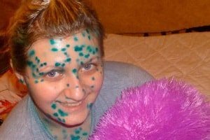 Детские болезни у взрослых: что нужно знать