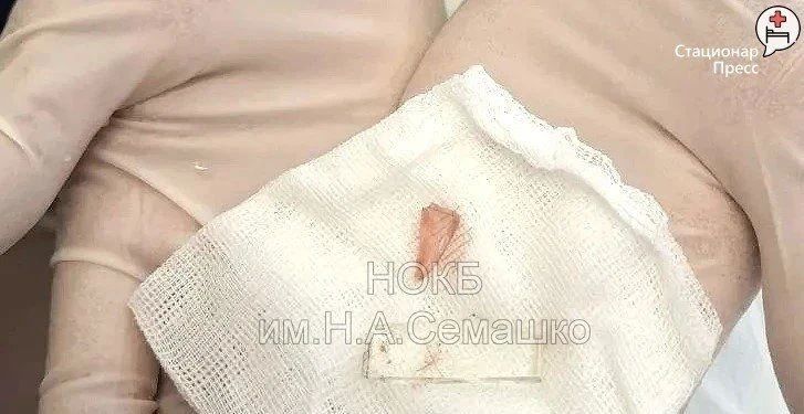 Врачи из больницы им. Семашко достали из шеи нижегородки большой кусок стекла