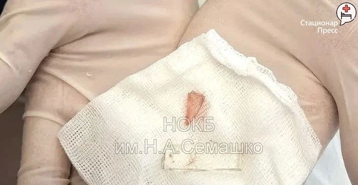 Врачи-ювелиры НОКБ им.Семашко извлекли осколок стекла из шеи нижегородки Врачи-ювелиры НОКБ им.Семашко извлекли осколок стекла из шеи нижегородки