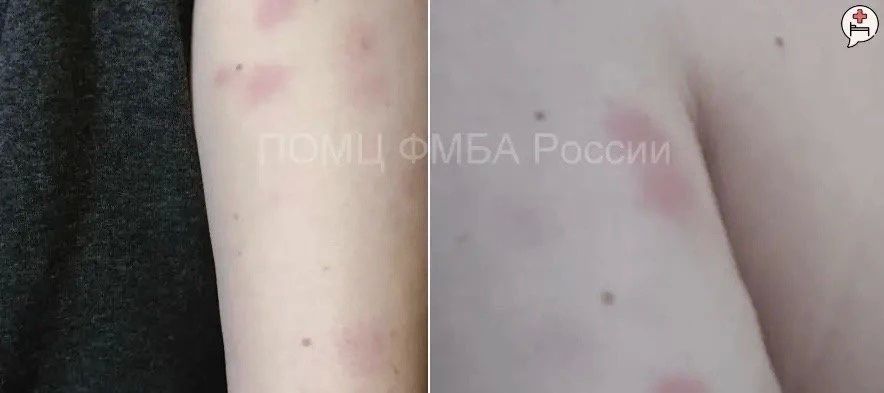В Нижнем Новгороде зафиксированы случаи укусов постельных клопов