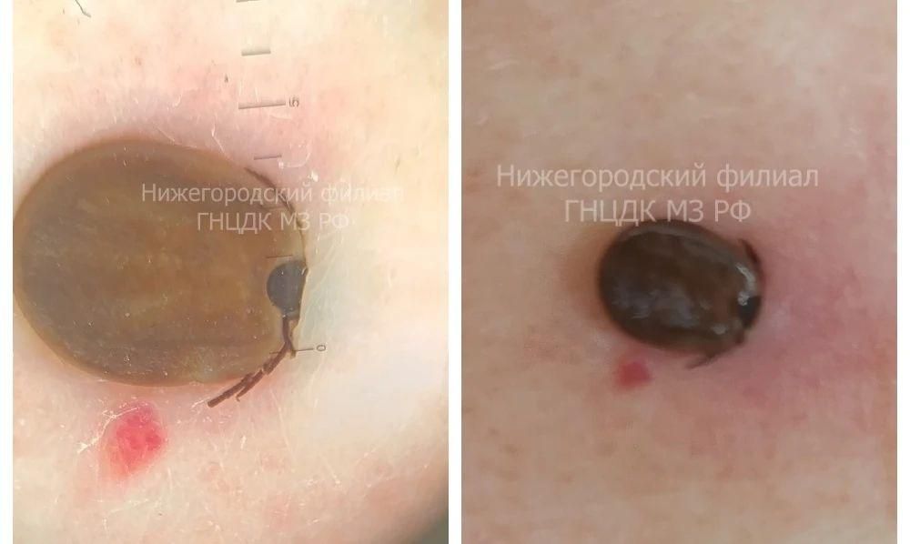 Плюс одна фобия в копилочку — нижегородка не заметила на своём теле клеща, приняв его за родинку